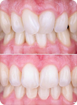 Aligner Behandlung