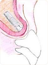 Correction de la position et de l´aspect de la gencive grâce à la chirurgie plastique