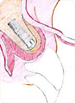 Rolled split-flap over implant for aesthetical correction of the gum