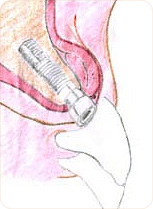 Correction de la position et de l´aspect de la gencive grâce à la chirurgie plastique